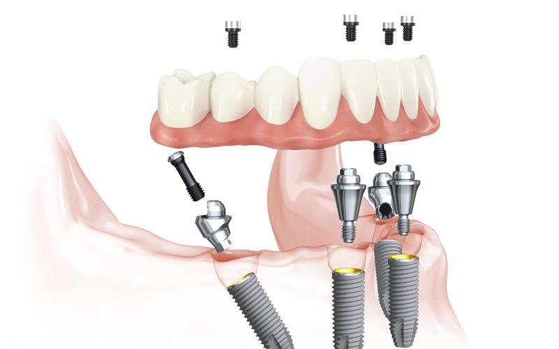 Illustration of an All-on-4 lower arch: two upright front implants and two tilted back implants holding a full bridge of teeth