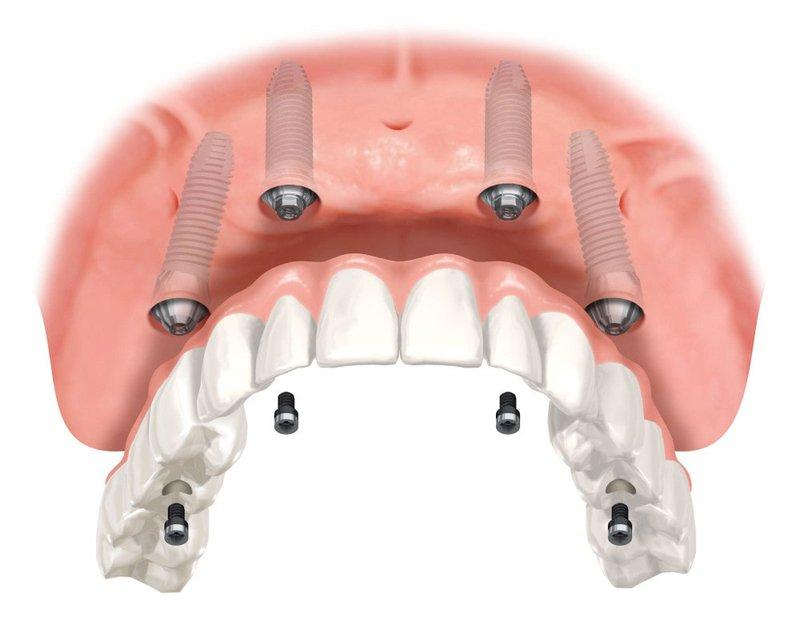 Illustration of an All-on-4 upper arch from below: four implants and the bridge that screws onto them