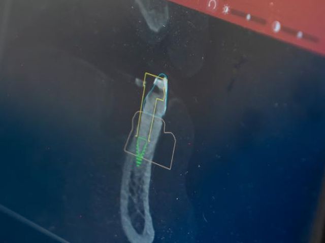 A single implant planned on the CBCT 3D scan, on screen at Astley Dental Centre